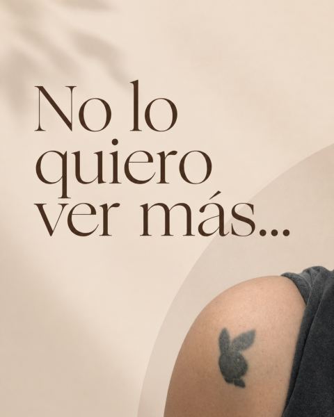 Remoción láser de tatuajes