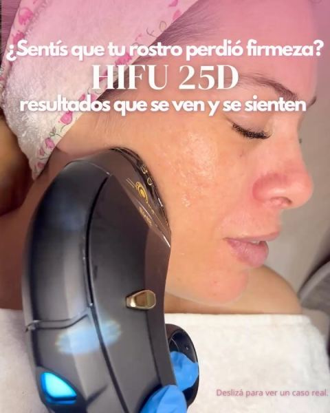 HIFU facial