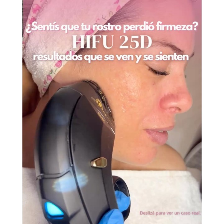 HIFU facial