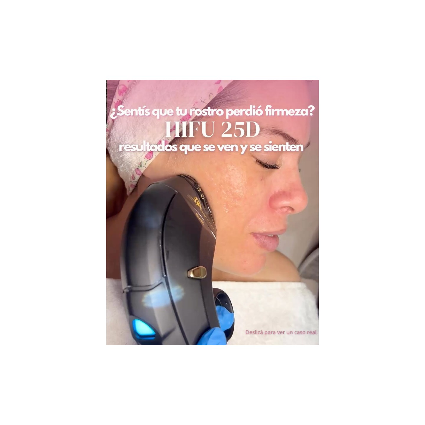 HIFU facial
