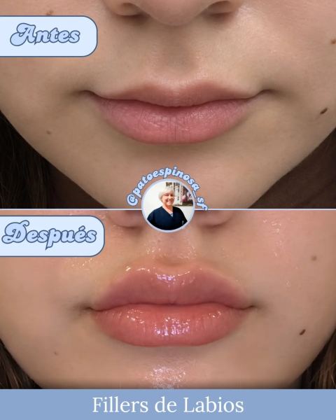 Relleno de labios con ácido hialurónico