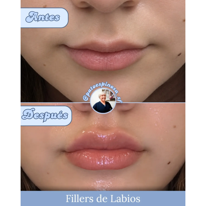 Relleno de labios con ácido hialurónico