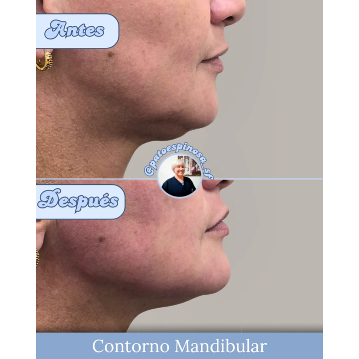 Contorno mandibular