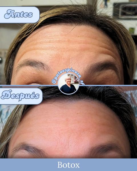 Toxina botulínica facial