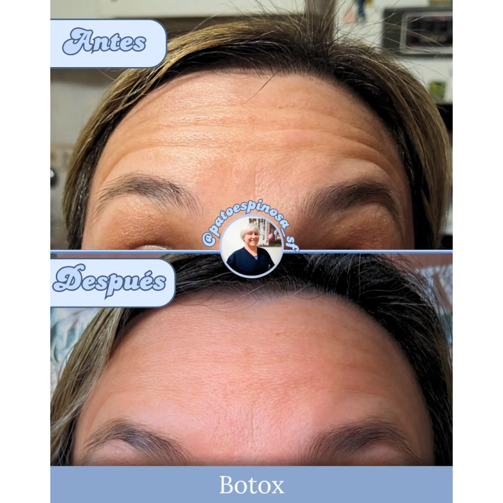 Toxina botulínica facial