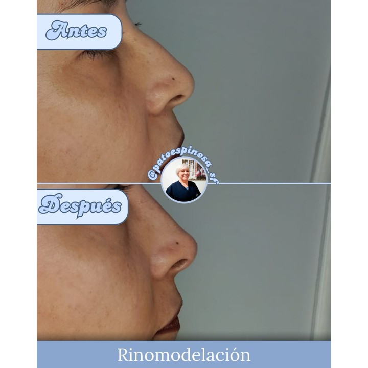 Rinomodelación con ácido hialurónico