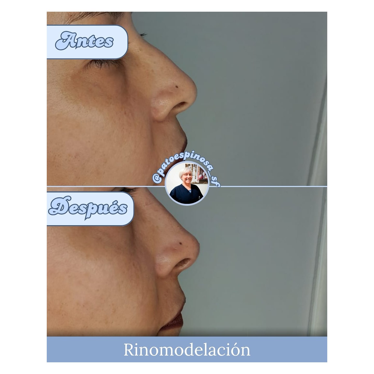 Rinomodelación con ácido hialurónico