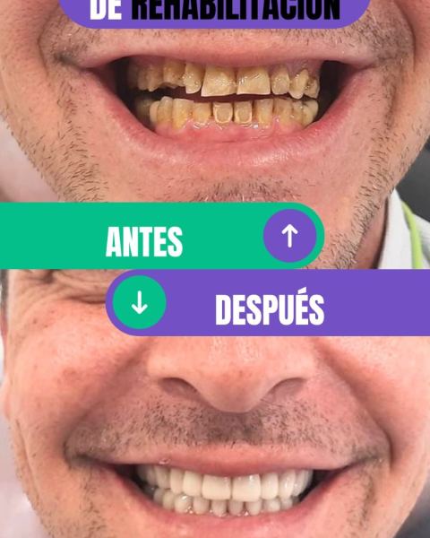 Rehabilitación oral