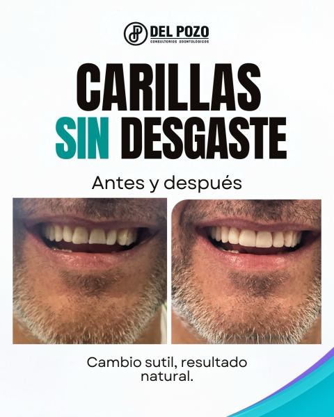 Carillas dentales