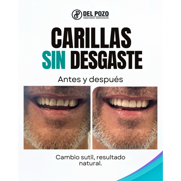 Carillas dentales
