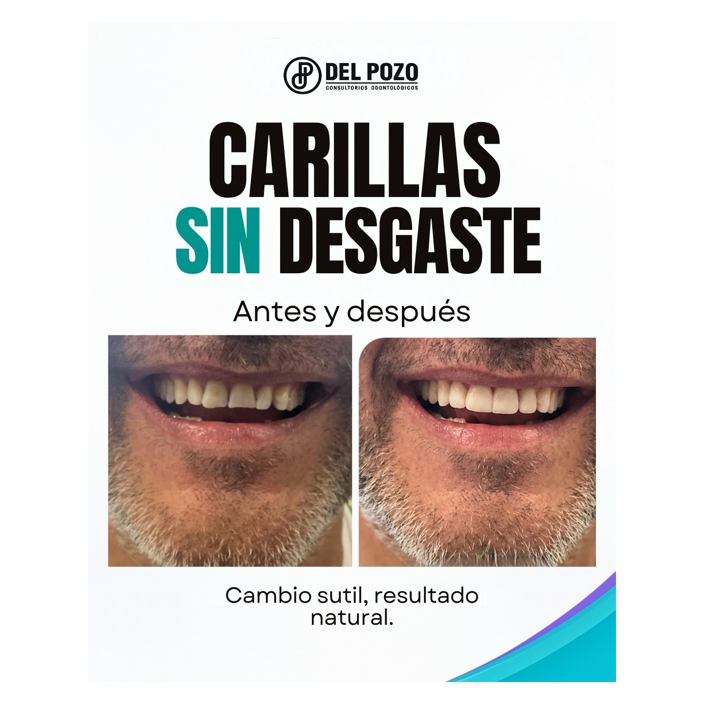 Carillas dentales