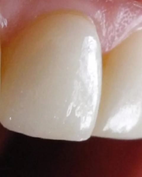 Carillas dentales