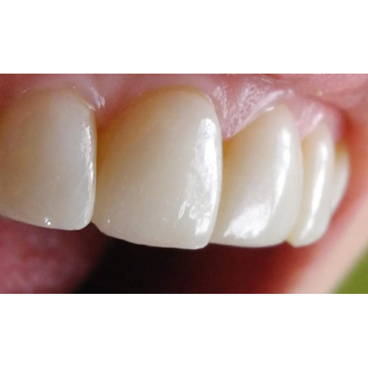 Carillas dentales