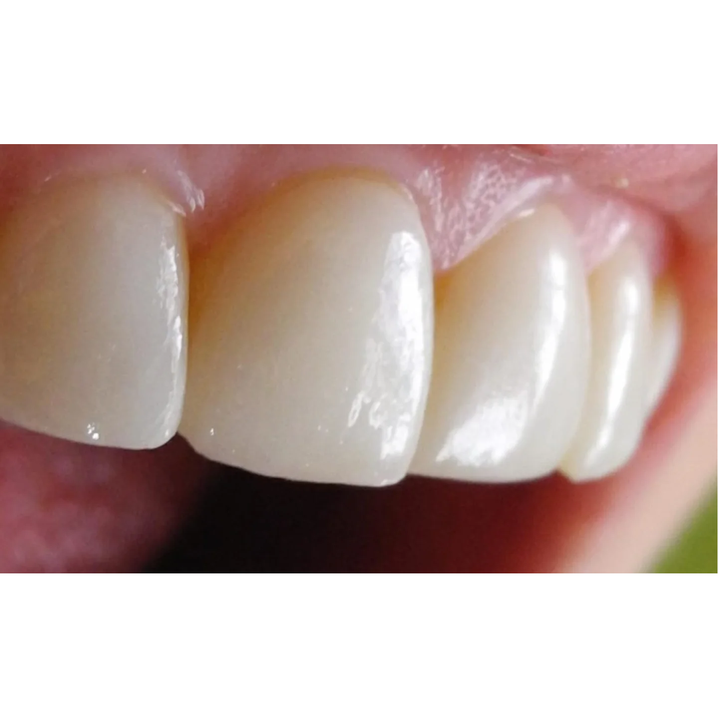Carillas dentales