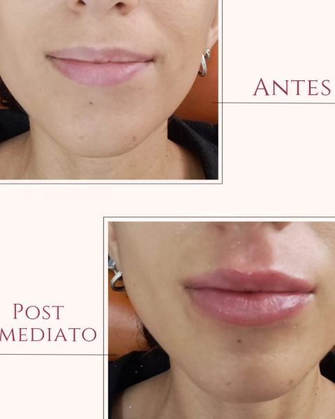 Armonización orofacial