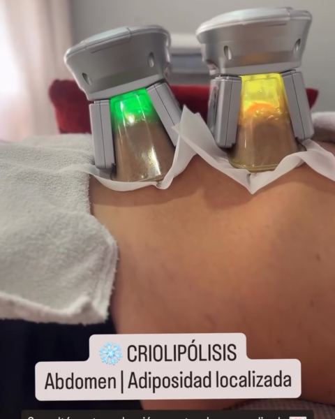 Criolipólisis