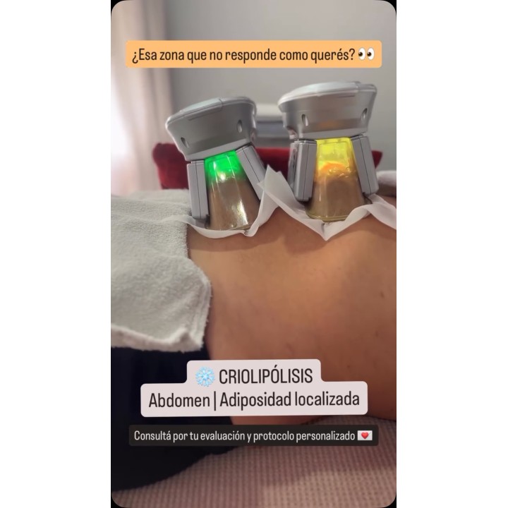 Criolipólisis