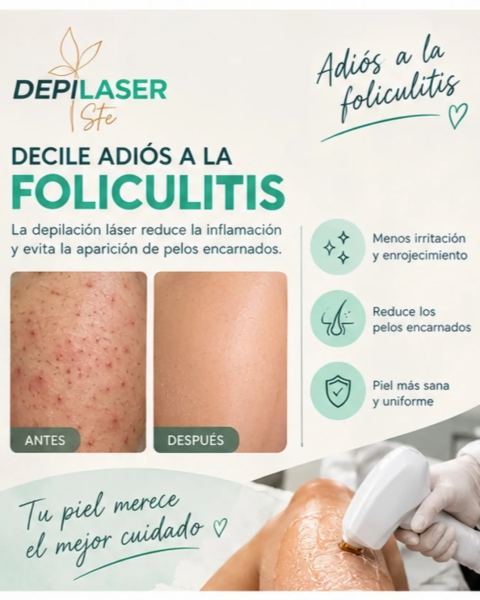Tratamiento láser para la foliculitis
