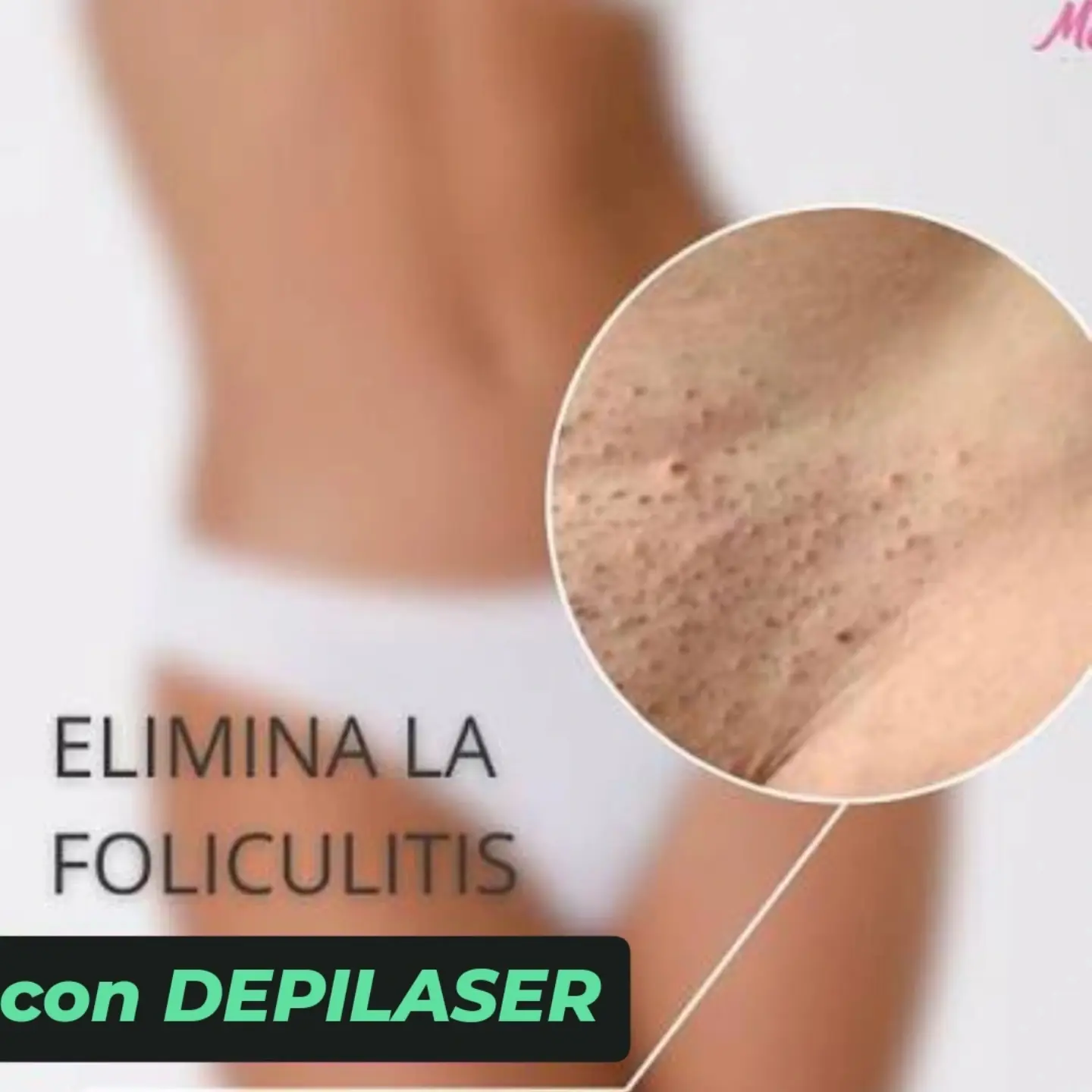 Tratamiento láser para la foliculitis