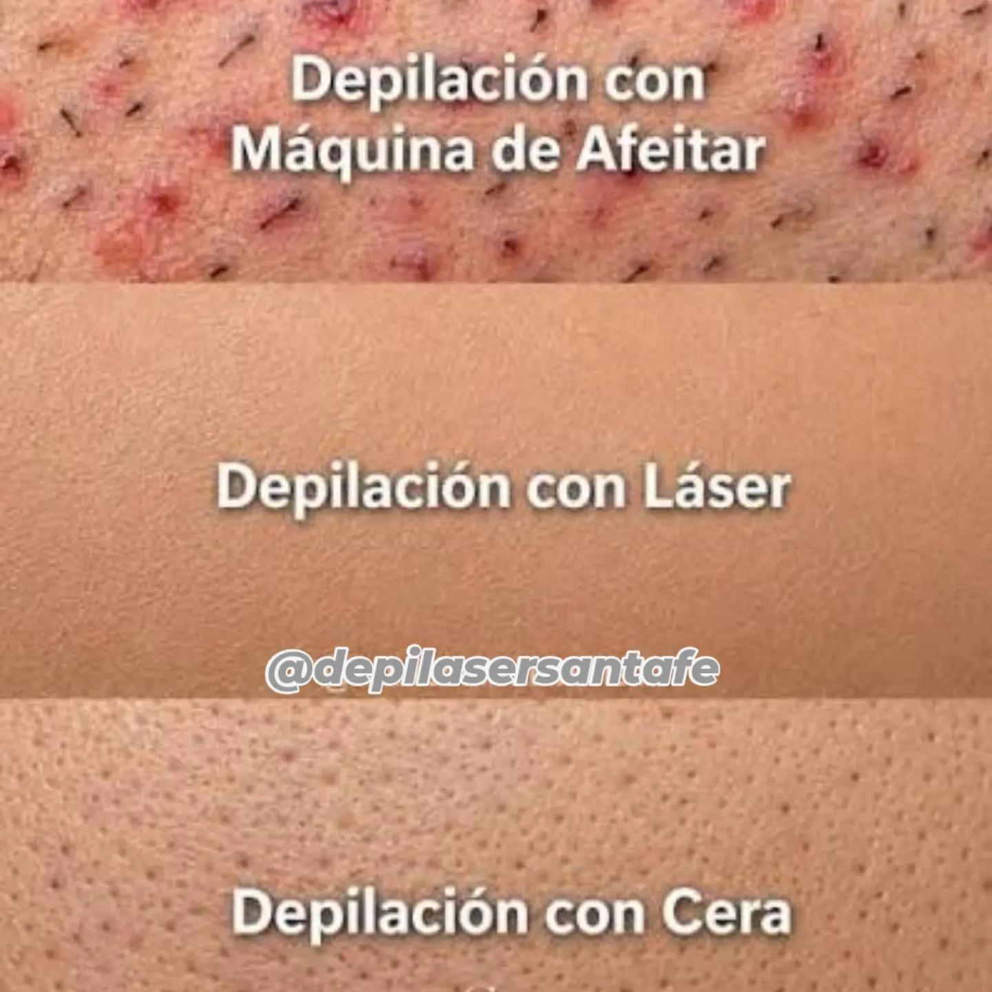 Tratamiento láser para la foliculitis