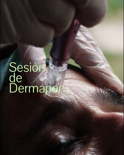 Sesión de Dermapen