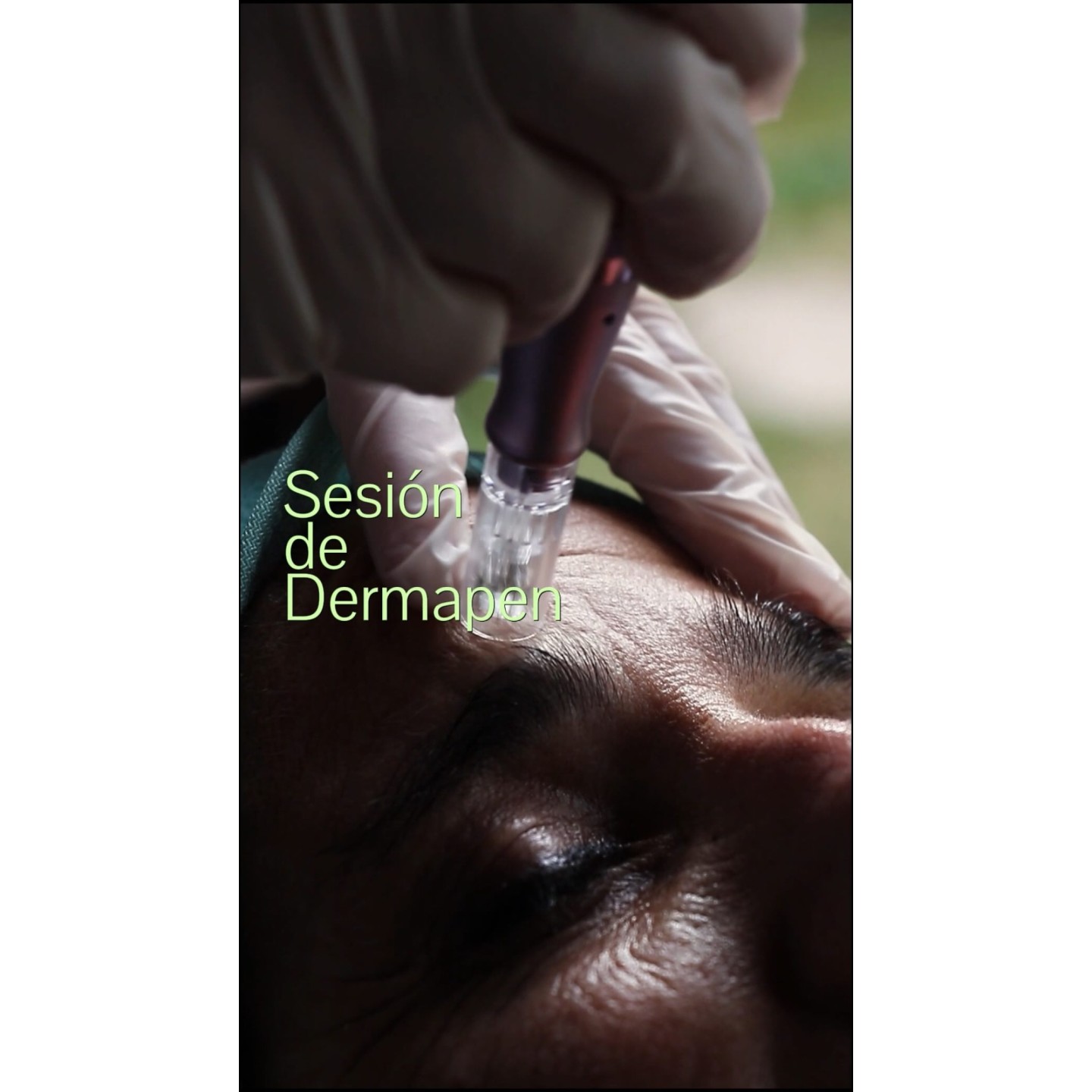 Sesión de Dermapen